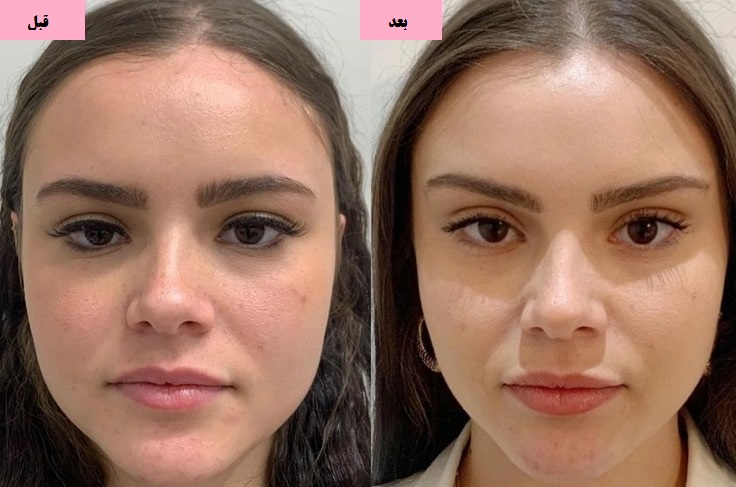 لیفت ابرو با نخ