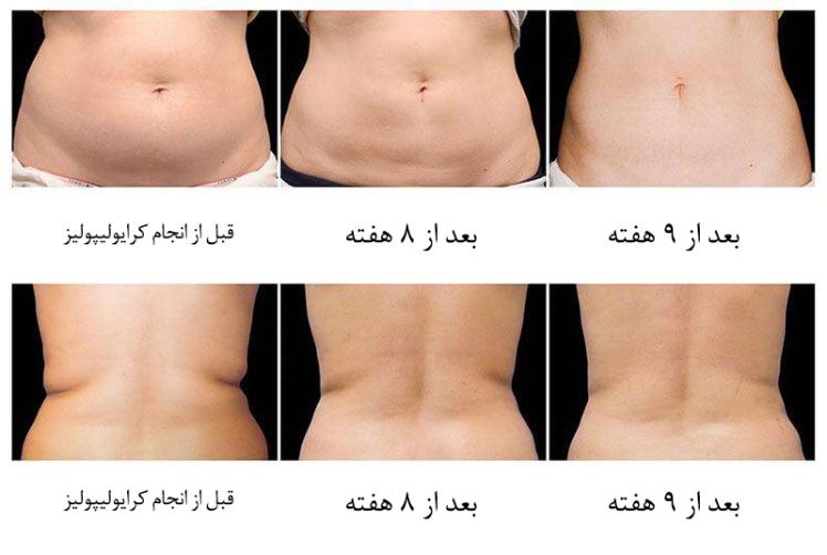 کرایولیپولیز