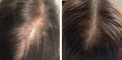 مزوتراپی مو