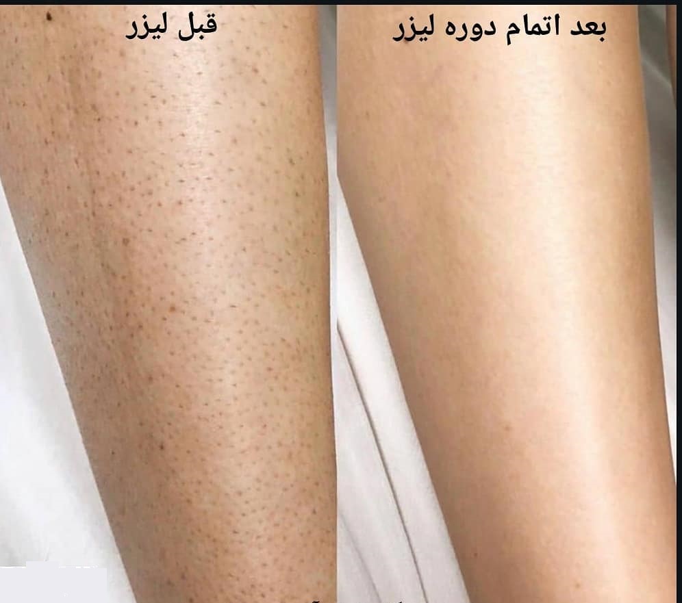 لیزر موهای زائد