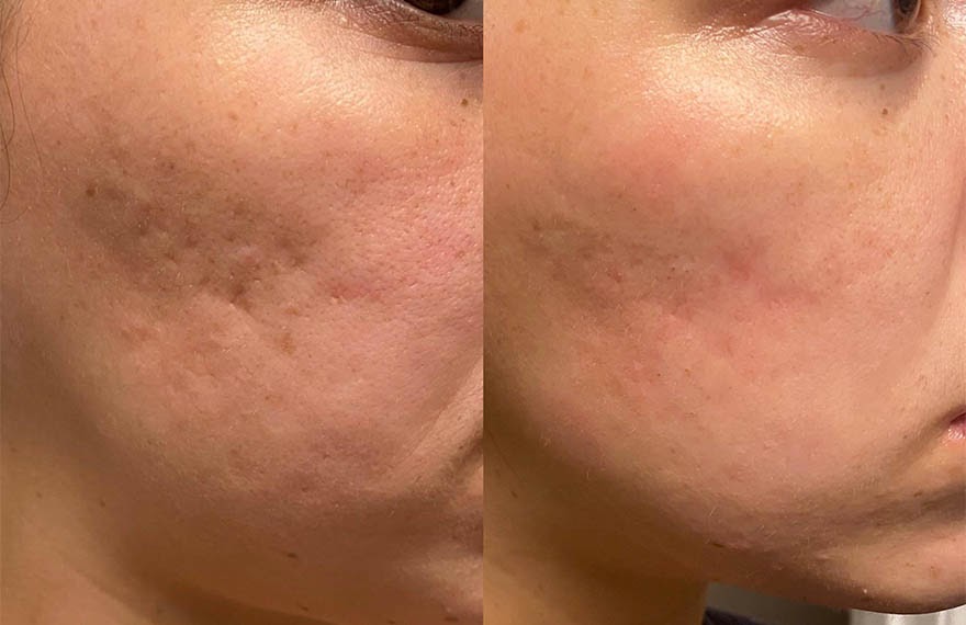 میکرونیدلینگ