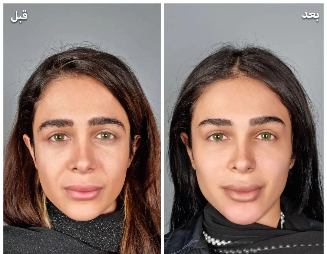 فیلر خط خنده