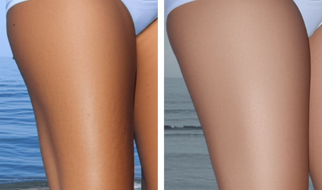 کاهش چربی ران